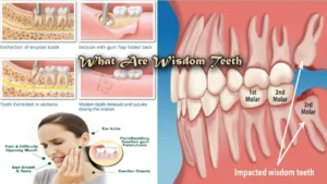 Why Wisdom Teeth Hurt in the First Place
