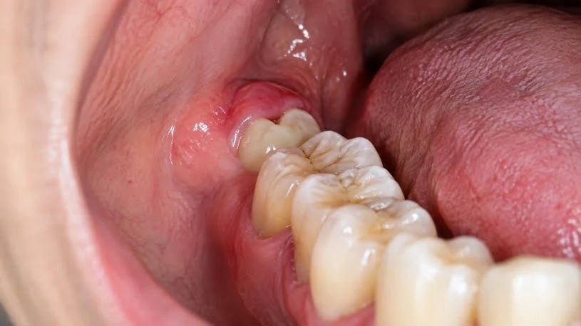 First Signs of Wisdom Teeth Coming In